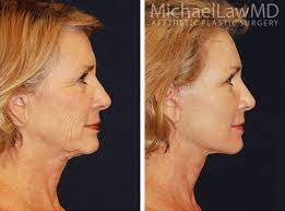 Boost Confidence with Personalized Rhinoplasty Washington DC